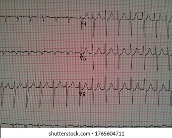 EKG With Rhythm Strip Showing Tachycardia On Chest Leads