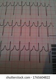 EKG Rhythm Strip Showing Tachycardia, QRS And T-waves