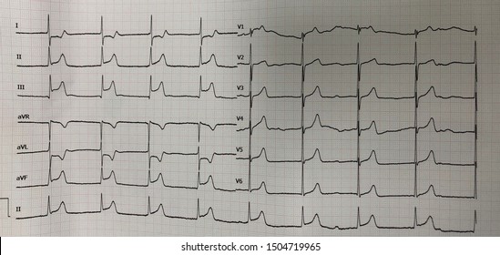EKG showed STEMI inferior wall with RV infarction - Shutterstock ID 1504719965