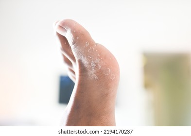 Eksofiliasi Dried Skin Peeling Off From Under Foot.