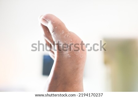 eksofiliasi dried skin peeling off from under foot.