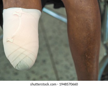 Elastic bandaged below knee amputation