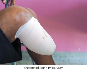 Elastic bandaged below knee amputation