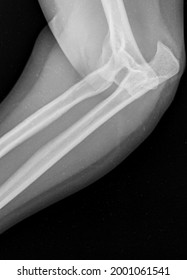 Elbow Dislocation  Broken Hand Xray Radiology