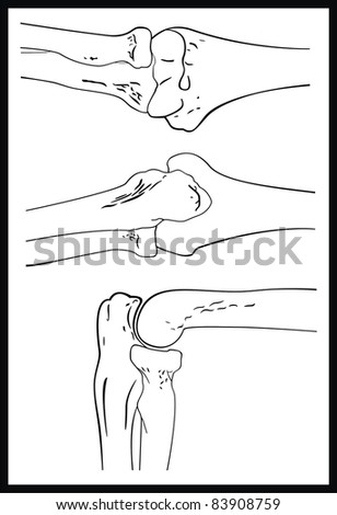 Elbow Joint - Front, Back and Lateral View