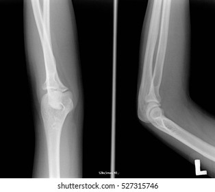 Elbow Tomography