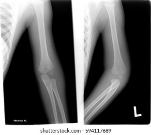 Xray Image Elbow Showing Fractures Dislocation Stock Photo (Edit Now ...