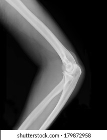 Elbow Xray