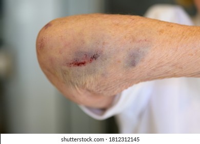 Elderly 80-year Old Woman With A Broken Or Fractured Elbow Joint Showing The Soft Tissue Damage And Trauma To Her Arm From The Injury