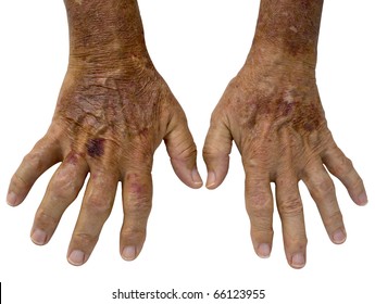 Age Spots Hands Hd Stock Images Shutterstock