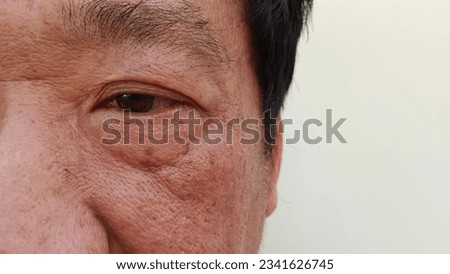 Elderly man with acne, blemishes, freckles, scars, wrinkles on the face.