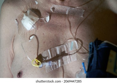 An elderly patient with a Port-A-Cath Implanted Under Skin into a large central vein. Intravenous drugs are allowed to implantable Port-A-Cath for chemotherapy.