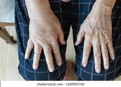 Elderly Swollen Hand Or Edema Hand