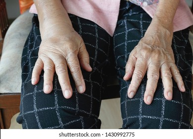 Elderly Swollen Hand Or Edema Hand