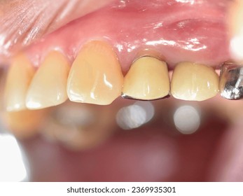 an elderly teeth, preparing for implant dental, implant, before and after implant, missing teeth, a problem of dirt, tartar.  - Shutterstock ID 2369935301