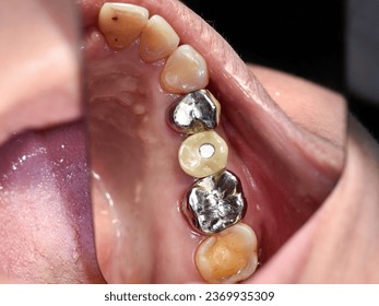 an elderly teeth, preparing for implant dental, implant, before and after implant, missing teeth, a problem of dirt, tartar.  - Shutterstock ID 2369935309