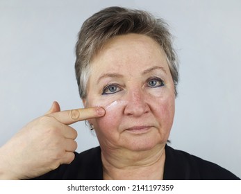 An elderly woman applies an anti-aging face cream. Cosmetology. Withering (aging) of the skin. Pigmentation. Couperose.