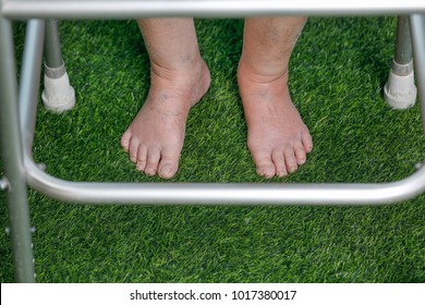 Elderly Woman Bare Swollen Feet On Grass With Walker 