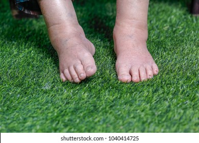 Elderly Woman Bare Swollen Feet On Grass 