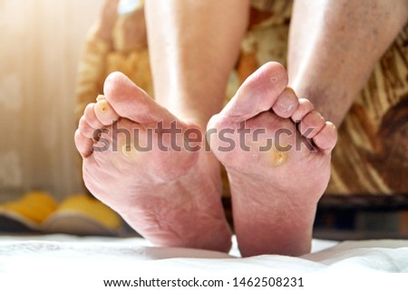 An elderly woman feet with podagra, fungus and diabetic ucler, callus. Healthcare concept
