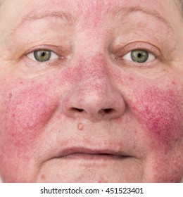 Elderly Woman With Rosacea, Facial Skin Disorder, Portrait