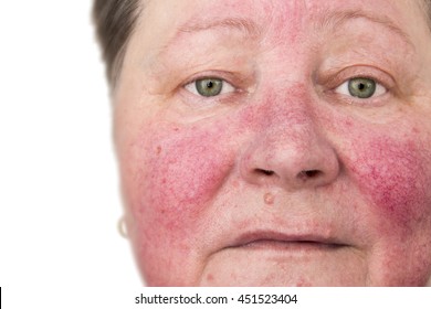 Elderly Woman With Rosacea, Facial Skin Disorder, Portrait