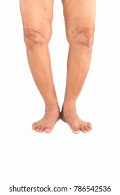 Elderly Woman Varus Deformity Or Bow Legs.elderly Health Concept