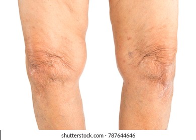 Elderly Woman Varus Deformity Or Bow Legs.health Concept