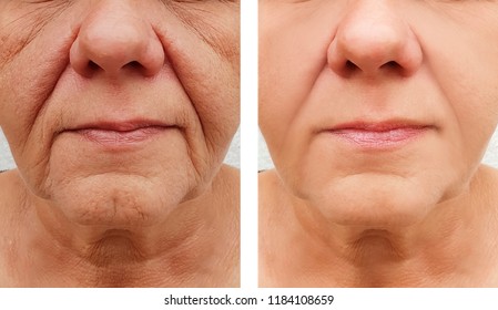 Elderly Woman Wrinkles On Face, Before And After Procedures
