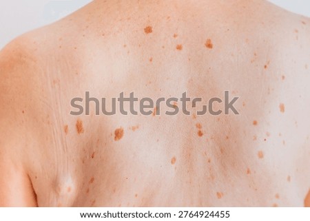 Elderly woman's back showing multiple pigmented lentigo spots, age-related skin changes, with natural skin texture.
