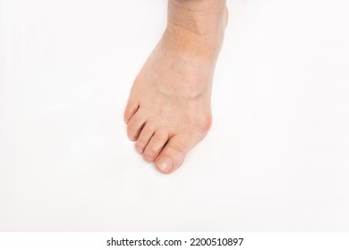 Elderly Woman's Foot With Hallux Valgus Deformity Of The Big Toe Caused By Wearing Uncomfortable Shoes Isolated On A White Background. Orthodontics