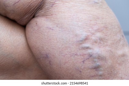 An Elderly Woman's Hand Touches Her Sick Leg With Vein Thrombosis, Varicose Veins.