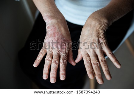 The elderly woman's hands are affected by psoriasis. Psoriasis skin. Closeup of rash and scaling on the patient's skin. The concept of chronic disease treatment. Dermatological problems. 