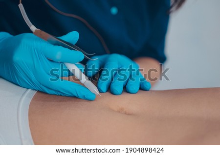 Electro epilation procedure close up. Bikini zone