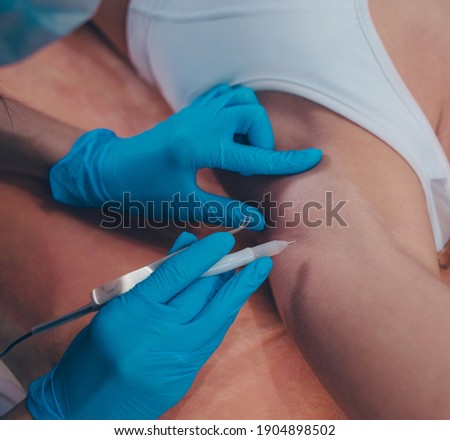 Electro epilation procedure close up.