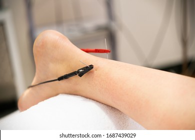 Electro-acupuncture dry with needle connecting machine. Electro stimulation in physical therapy.
