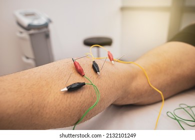 electroacupuncture with the needle connection machine used by the acupuncturist in men. Electrical stimulation in physiotherapy to the twin of a young man in the physiotherapy center.