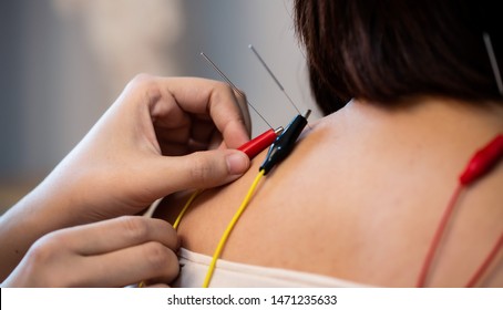 Electro-Acupuncture.Traditional Chinese acupuncture and Electro acupuncture on body of patient