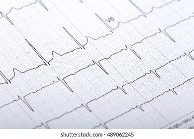 electrocardiogram