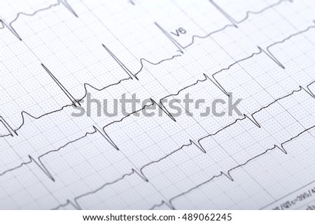 electrocardiogram