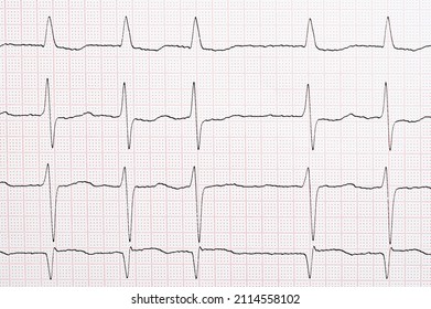 Electrocardiogram with arrhythmia due to atrial fibrillation 