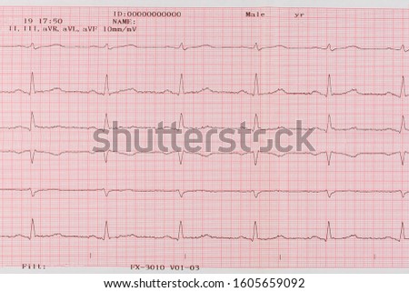 Electrocardiogram close - up in paper form