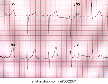 Electrocardiogram Ecg Printout Ekg Background Stock Photo 693002374 ...