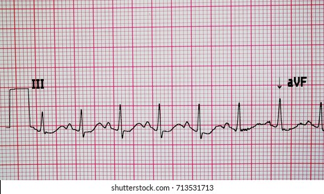 Electrocardiogram Ecg Printout Ekg Background Stock Photo 713531713 ...