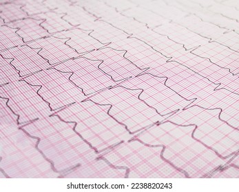 Electrocardiogram example of a normal 12-lead sinus rhythm, close up
