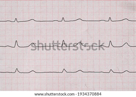 Electrocardiogram with normal frequency sinus rhythm 
