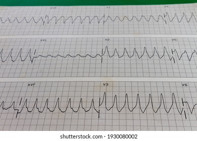 Electrocardiogram Of A Patient With High-rate Cardiac Arrhythmia. Ventricular Tachycardia With Wide QRS. Ventricular Arrhythmia Leading To Heart Attack.