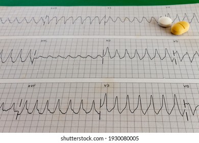 Electrocardiogram Of A Patient With High-rate Cardiac Arrhythmia. Ventricular Tachycardia With Wide QRS. Ventricular Arrhythmia Leading To Heart Attack.