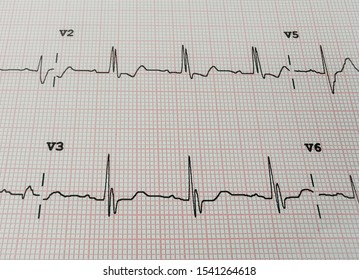 Electrocardiogram (RBBB) Is A Heart Block In The Right Bundle Branch Of The Electrical Conduction System.