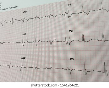 Electrocardiogram (RBBB) Is A Heart Block In The Right Bundle Branch Of The Electrical Conduction System.